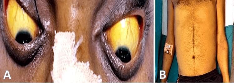 This composite clinical photograph displays physical manifestations of hyperbilirubinemia in a 35-year-old male. Image A provides a close-up view of the patient's eyes, demonstrating severe scleral icterus characterized by a deep yellow discoloration of the bulbar conjunctiva and sclera. The irises, pupils, and surrounding periorbital skin are also visible. Image B is a frontal view of the patient's torso and upper limbs, showing generalized jaundice (icterus) manifested as a diffuse yellowing of the skin across the chest, abdomen, and arms. Visible landmarks include the umbilicus and sparse terminal hair on the chest and linea alba. An intravenous (IV) catheter is noted on the right forearm, secured with medical tape. These findings are classic clinical signs of hepatic or biliary pathology, such as alcoholic hepatitis, cirrhosis, or obstructive jaundice, reflecting a systemic buildup of bilirubin.