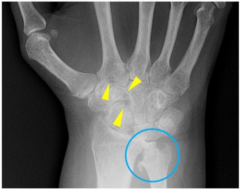 This diagnostic image is a posteroanterior (PA) radiograph of the wrist and proximal hand in a 57-year-old female patient with rheumatoid arthritis. The imaging demonstrates classic features of chronic inflammatory arthritis. Scattered marginal erosions are visible within the carpal bones, specifically highlighted by yellow arrowheads, indicating loss of cortical integrity in the 'bare areas' of the joints. A blue circle highlights the distal radius and ulna, which exhibit moderate peri-articular demineralization. This demineralization is characterized by reduced radiopacity and a sparse, less distinct trabecular pattern compared to healthy bone. The visual findings illustrate the progression of rheumatoid arthritis, where synovial inflammation leads to hyperemia and subsequent bone resorption and erosion before significant joint space narrowing is observed. These features are clinically significant for the assessment of disease activity and structural damage in rheumatological disorders.