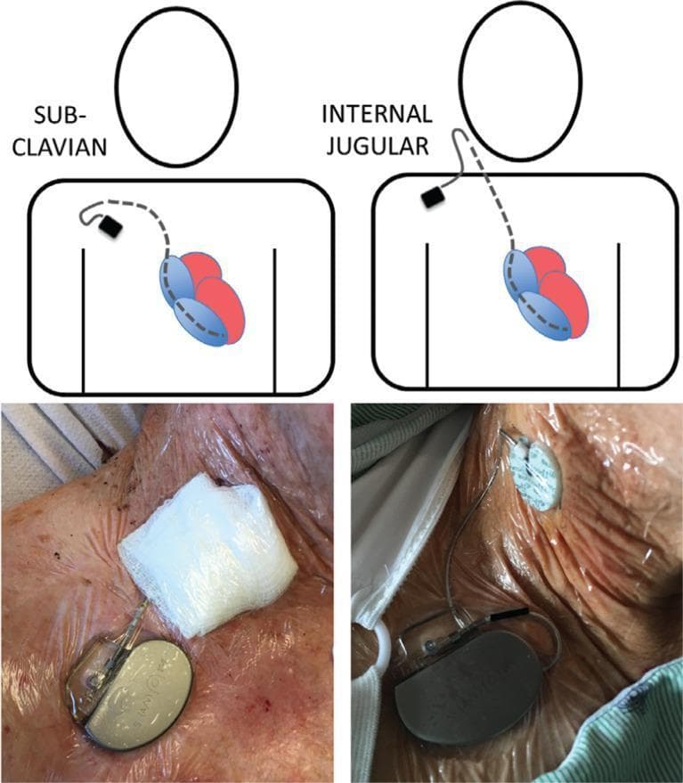 This composite educational graphic illustrates two common approaches for Temporary Permanent Pacemakers (TPPM). The top panel features anatomical diagrams showing venous access routes: the left diagram demonstrates the subclavian approach with a lead entering the left subclavian vein and progressing toward the right atrium and ventricle; the right diagram shows the internal jugular approach with a lead entering via the neck. The bottom panel contains clinical photographs of these procedures. In both cases, an external pacemaker generator is positioned on the patient's upper chest wall, secured to the skin with transparent adhesive dressings. One photograph shows the insertion site covered with a bulky white gauze dressing (left), while the other shows the use of a circular adhesive stabilizing device and a transparent dressing (right). This visual aid is designed for medical education, specifically in cardiovascular surgery and intensive care, to demonstrate lead management, insertion anatomy, and securement techniques for temporary cardiac pacing.