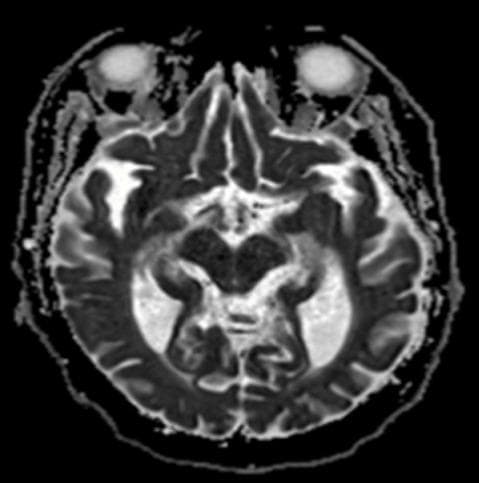 This diagnostic image is an axial magnetic resonance imaging (MRI) scan of the human brain utilizing an apparent diffusion coefficient (ADC) map sequence. The cross-section is taken at the level of the midbrain and temporal lobes, with the orbits visible anteriorly. The primary pathology is a focal area of marked hypointensity (low signal) located in the left medial temporal lobe, specifically involving the hippocampal region. This hypointense signal on the ADC map corresponds to restricted diffusion, which is a classic radiographic sign of acute cytotoxic edema. In this clinical context, the finding represents a metabolic insult likely secondary to severe hypoglycemia. The surrounding brain parenchyma, including the contralateral hippocampus and the cortical ribbons of the temporal and occipital lobes, maintains relatively normal signal intensity. This visual is used to demonstrate the neurological consequences of severe metabolic disturbances and the utility of diffusion-weighted imaging (DWI/ADC) in identifying acute brain lesions that may not be apparent on standard CT scans.