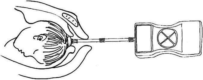 This schematic diagram illustrates a self-developed internal tocodynamometry machine used for monitoring fetal head descending thrust during labor. The illustration depicts three primary components: a pressure-sensitive sensor, a connecting rod, and an external monitoring unit. The sensor is shown in direct contact with the crown of a fetal head in the cephalic position, stabilized by a clinician's hand. A linear connecting rod, featuring three reinforcement bands, transmits the physical force from the sensor to the external device. The rectangular monitoring unit contains a display screen on the left and a circular dial with a cross-quadrant interface on the right. This diagnostic setup is designed to measure intrauterine pressure and fetal descent forces at specific stages of cervical dilation (3-5 cm, 5-8 cm, and 8-10 cm). The educational focus is on the instrumentation and clinical application of internal monitoring to assess labor progression and predict the necessity for emergency obstetric interventions.