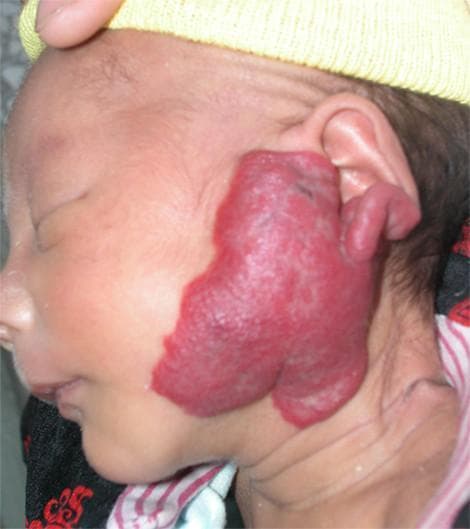 This clinical photograph displays a 40-day-old infant in a lateral view, showcasing a large infantile hemangioma in the left parotid and auricular region. The lesion is a prominent, irregularly shaped, raised plaque characterized by a vibrant crimson-to-purple hue and a lobulated, strawberry-like surface texture. The vascular mass extends from the preauricular cheek area posteriorly, partially involving and distorting the left pinna and external ear structures. The margins are well-defined against the surrounding light-toned skin. This image serves as a clinical example of a proliferative phase infantile hemangioma, a common benign vascular tumor of childhood, specifically located in the parotid area which requires monitoring for potential impact on deeper structures or functional impairment of the ear canal.