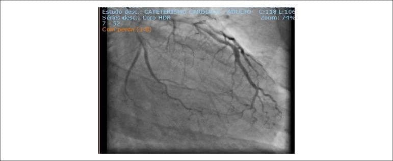 This diagnostic image is a coronary angiogram obtained during cardiac catheterization, showing the left coronary artery system in an adult patient. The primary focus is the left anterior descending artery (LAD), which displays a large caliber and significant longitudinal extension, reaching toward the apex and branching into the posterior interventricular sulcus. Also visible is the circumflex artery (LCx), which appears non-dominant and of relatively shorter extension, giving rise to an atrioventricular branch. The imaging specifically highlights the coronary anatomy and evaluates for the presence of collateral circulation; notably, the image demonstrates an absence of collateral flow from the left-sided circulation to the right coronary artery (RCA) territory. The vasculature is clearly delineated with radiopaque contrast, allowing for the assessment of vessel morphology, caliber, and the exclusion of obstructive coronary atherosclerosis in the visualized segments. This image serves as a clinical teaching tool for coronary anatomy, dominance patterns, and the evaluation of ischemic heart disease via invasive hemodynamic monitoring.