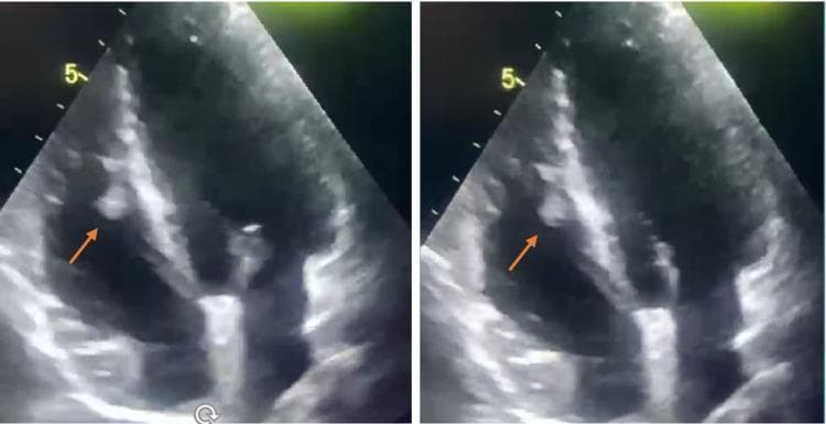 Two side-by-side frames of a transthoracic echocardiogram (TTE) in an apical four-chamber view, demonstrating a right ventricular mural thrombus. The right ventricle (RV) is prominently displayed on the left side of the ultrasound sector. An orange arrow in both panels points to a distinct, hyperechoic, lobulated mass attached to the endocardial surface of the right ventricular free wall. The mass exhibits a texture different from the surrounding myocardium and is situated within the ventricular cavity, appearing mobile and suggestive of a mural thrombus. The interventricular septum and left ventricle are also partially visualized. This clinical imaging illustrates an intracardiac complication often associated with Behçet's disease and other systemic inflammatory conditions or prothrombotic states. It serves as an educational example for identifying right-sided cardiac masses and assessing their echogenicity, mobility, and anatomical attachment via diagnostic ultrasound.