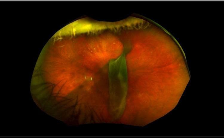 Ultra-widefield fundus photograph showing a complex retinal detachment in the left eye. The retina exhibits a predominantly orange-red hue with notable pathological alterations. A prominent, vertically oriented, bright green band or fold bisects the central retinal field, representing a significant structural irregularity or retinal tear. The superior peripheral retina appears highly elevated, translucent, and wrinkled, characteristic of subretinal fluid accumulation and corrugated retinal folds seen in rhegmatogenous retinal detachment. This diagnostic image demonstrates typical features of a large retinal tear where the neurosensory retina has separated from the underlying retinal pigment epithelium. The visibility of the eyelashes at the superior and lateral margins confirms the procedural nature of the wide-angle imaging. This clinical finding is highly significant for ophthalmological training, illustrating the 'black curtain' phenomenon and structural changes necessitating urgent surgical intervention like vitrectomy and scleral buckling.