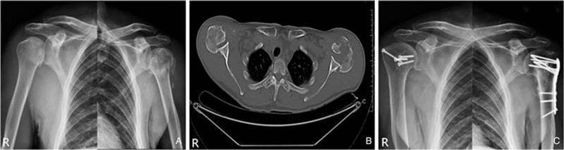 This composite educational graphic depicts the diagnostic imaging and postoperative management of bilateral posterior shoulder fracture-dislocations. (A) Anteroposterior (AP) radiographs of both shoulders demonstrate bilateral proximal humeral fractures. The humeral heads show a loss of normal overlap with the glenoid fossa, manifesting as the 'light bulb sign,' which is characteristic of internal rotation in posterior dislocations. (B) An axial CT scan through the glenohumeral joints provides definitive visualization of the pathology: a posterior 2-part fracture-dislocation on the right side and a complex posterior 4-part fracture-dislocation on the left side, where the humeral head is displaced posterior to the glenoid. (C) Postoperative AP radiographs illustrate the results of open reduction and internal fixation (ORIF). The right proximal humerus is stabilized with multiple cancellous bone screws, while the left humerus is reconstructed using an anatomical locked plating system. The images demonstrate successful restoration of glenohumeral alignment and stable internal fixation of the fractures.