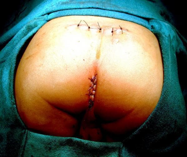 This clinical photograph shows the perineal and sacral region of a pediatric patient immediately following a Sagittal Sacroperineal Anorectoplasty (SSARP) for the correction of an anorectal malformation. The patient is in a prone position, surrounded by green surgical drapes. Two distinct surgical closure sites are visible. Superiorly, a horizontal (transverse) incision located just above the coccygeal region is closed with approximately four dark-colored, non-absorbable interrupted sutures. Inferiorly, a vertical incision at the newly created anal site is closed with a continuous suture pattern using similar dark material. Notably, the posterior midline skin between these two incisions remains entirely intact and spared, a characteristic feature of the SSARP technique that distinguishes it from the Posterior Sagittal Anorectoplasty (PSARP). The surrounding skin appears healthy with no signs of excessive inflammation, significant edema, or bruising. This image serves as a clinical example of postoperative anatomy in pediatric colorectal surgery, illustrating successful wound closure with preservation of midline skin integrity.
