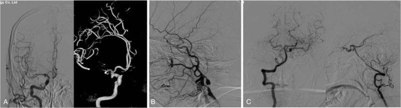 Cerebral digital subtraction angiography (DSA) images illustrating complex neurovascular pathology. Panel A shows a right internal carotid artery (ICA) angiogram in both standard and 3D reconstruction modes, revealing a saccular aneurysm at the posterior communicating artery (PCoA) segment. Panel B depicts the left carotid system, highlighting significant focal stenosis at the origin of the internal carotid artery, resulting in compromised distal contrast opacification and delayed perfusion. Panel C demonstrates left vertebral artery angiography, illustrating the posterior circulation and its involvement in the patient's vascular anomalies. The imaging series serves as a diagnostic tool for evaluating bilateral carotid artery communicating aneurysms and concomitant severe atherosclerotic stenosis. These findings are clinically significant in the context of neurosurgical planning for aneurysm clipping or endovascular coiling and stenting to mitigate the risk of subarachnoid hemorrhage and ischemic stroke.
