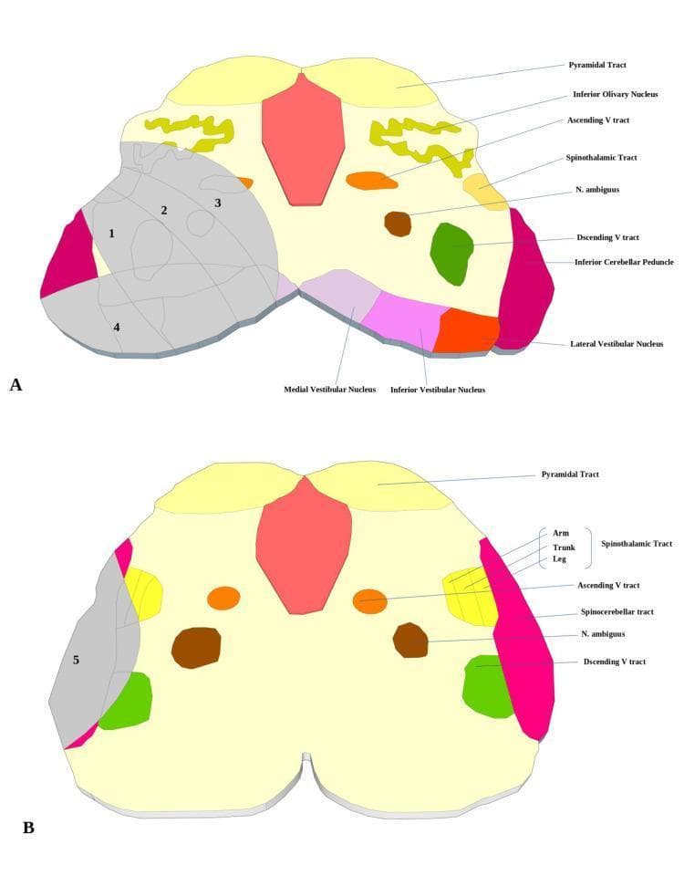 This medical diagram illustrates the cross-sectional neuroanatomy and clinical pathology of the brainstem at the rostral (A) and caudal (B) medullary levels. The illustrations use color-coding and numerical labeling (1-5) to demonstrate common patterns of Lateral Medullary Infarction (Wallenberg Syndrome). In the rostral level (A), labeled structures include the Pyramidal tract, Inferior Olivary Nucleus, Ascending V tract, Spinothalamic tract, Nucleus ambiguus, Descending V tract, and various vestibular nuclei (Medial, Inferior, and Lateral). In the caudal level (B), the diagram adds detail to the Spinothalamic tract topography (Arm, Trunk, Leg) and shows the Spinocerebellar tract. Shaded gray regions indicate specific infarction subtypes: Typical (1+2), Ventral (2+3), Large (1+2+3), Dorsal (4), and Lateral (5). These sections highlight the vascular distribution of the Posterior Inferior Cerebellar Artery (PICA) and its clinical relevance in localizing brainstem strokes. The diagrams serve as an educational tool for correlating visual neuroanatomical landmarks with specific neurological deficits observed in medullary syndromes.