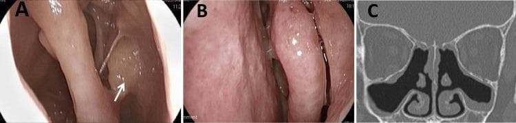 This composite figure illustrates the clinical and radiological response to treatment for eosinophilic chronic rhinosinusitis (ECRS) in an adult patient. Panel A displays a right-sided nasal endoscopy view showing a persistent, smooth, pale yellow-colored polypoid mass located within the olfactory fissure (marked by a white arrow). Panel B presents a left-sided nasal endoscopy view showing resolution of previously documented nasal polyps, with visible nasal mucosa and patent passages. Panel C is a coronal paranasal sinus CT scan following four months of therapy, demonstrating significant improvement in sinus aeration. The black, air-filled spaces within the maxillary, ethmoid, and frontal sinuses indicate reduced mucosal thickening and clearance of soft-tissue opacities, although residual mucosal thickening remains visible in the floor of the maxillary sinuses. Collectively, the images provide a comparison of endoscopically visible localized disease versus global sinus improvement monitored via diagnostic imaging.