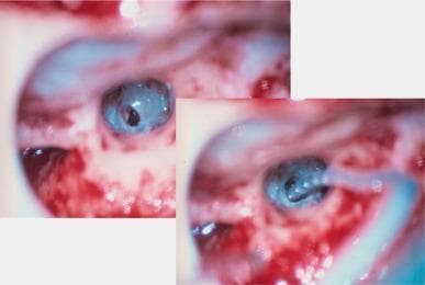 This clinical surgical photograph, captured via endoscopy, shows the intraoperative procedure of a cochlear implant electrode insertion through the round window. The image is split into two frames demonstrating a progression of the 'soft-surgery' technique. The left frame shows the preparation of the round window niche with a small incision or cochleostomy made in the round window membrane, appearing as a dark opening against the bluish-white surface of the membrane. The right frame illustrates the active insertion of the cochlear implant electrode carrier. The electrode is a thin, flexible, translucent cylindrical structure with visible dark internal components (contacts). It is being guided carefully through the opening in the round window to reach the scala tympani of the cochlea. The surrounding surgical field includes vascularized middle ear mucosa with characteristic reddish hue and anatomical landmarks of the tympanic cavity. This visual demonstrates the atraumatic insertion method intended to preserve residual hearing by minimizing mechanical damage to inner ear structures.