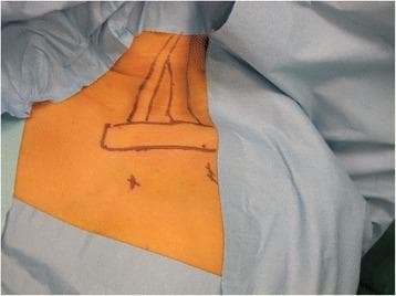 This clinical photograph displays the preoperative preparation of a patient's neck and chest region for arthroscopic release of the sternocleidomastoid (SCM) muscle, a procedure typically used to treat congenital muscular torticollis. The patient is in a supine position, with blue surgical drapes surrounding the sterile field. Anatomical landmarks are clearly delineated on the skin using a dark surgical marker. The markings outline the V-shaped sternal and clavicular heads of the SCM muscle as they converge toward the mastoid process. A horizontal rectangular box marks the superior border of the clavicle. Below the clavicle, two cross-marks indicate the planned sites for surgical access: the anteromedial portal (positioned inferior and medial to the sternoclavicular joint) and the working portal (positioned inferior to the midpoint of the clavicle). This visual serves to educate on surface anatomy palpation and the precise spatial orientation required for minimally invasive cervical muscle release.
