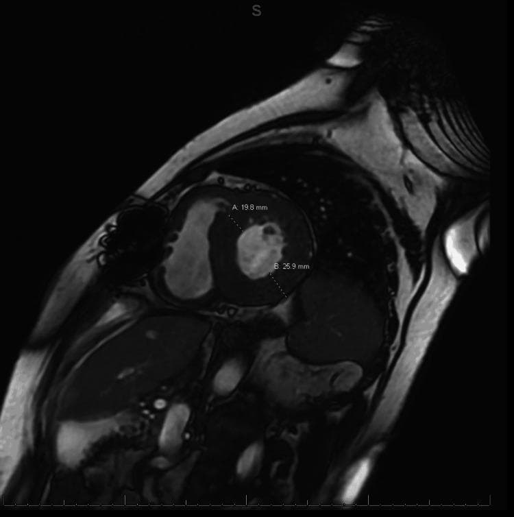 Diagnostic cardiac MRI in a short-axis view demonstrating significant concentric left ventricular (LV) hypertrophy. The image provides quantitative measurements of the myocardial wall thickness: marker 'A' identifies the anteroseptal wall at 19.8 mm, and marker 'B' identifies the posterior lateral wall at 25.9 mm, both significantly exceeding normal physiological limits. The LV chamber appears narrowed due to the increased wall mass. Surrounding anatomical structures including the right ventricle, chest wall, and lungs are visible in this transverse orientation. The imaging is used here to characterize structural changes consistent with infiltrative cardiomyopathies, such as cardiac amyloidosis, or severe hypertensive heart disease. This visual is suitable for advanced cardiology and radiology education focusing on hemodynamic assessment and structural heart disease.