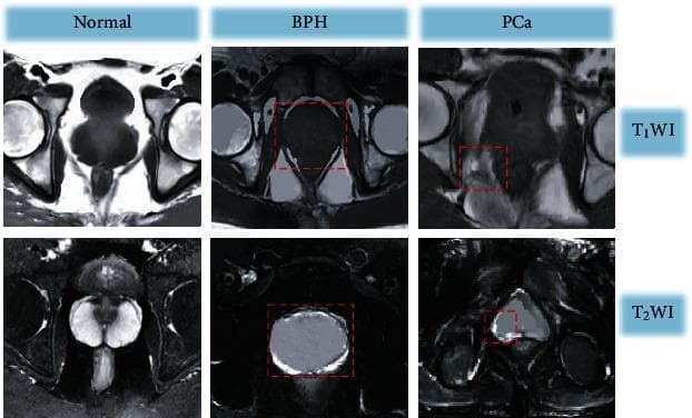 A comparative diagnostic MRI panel displaying axial views of the pelvic region to distinguish between Normal, Benign Prostatic Hyperplasia (BPH), and Prostate Cancer (PCa). The top row contains T1-weighted images (T1WI), while the bottom row shows T2-weighted images (T2WI). In the T1WI sequence, all three conditions present relatively homogeneous isosignals, making it difficult to differentiate the internal anatomy of the prostate. Red dashed boxes highlight regions of interest. In the T2WI sequence, significant diagnostic features are visible: the normal prostate displays a symmetrical high-signal crescent-shaped peripheral zone; BPH shows marked enlargement of the central and transitional zones while maintaining the peripheral high-signal crescent; and the PCa image demonstrates a loss of normal architecture with restricted low-signal areas in the peripheral zone and mixed signal intensity in the central region, indicative of neoplastic infiltration. These images serve as an educational comparison of signal intensity changes and morphological alterations in common prostatic pathologies.