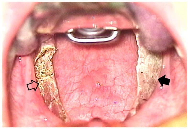 This intraoral clinical photograph provides a comparison chart view of the oropharynx immediately following bilateral extracapsular tonsillectomy. The image demonstrates two distinct surgical techniques applied to the left and right tonsillar fossae. The patient's right tonsillar fossa (indicated by a solid black arrow) shows the result of coblation tonsillectomy; the surgical bed appears relatively smooth, clean, and predominantly pinkish-red, indicating minimal thermal damage to the underlying tissue. In contrast, the patient's left tonsillar fossa (indicated by an open arrow) shows the result of monopolar electrocautery tonsillectomy. This area exhibits a yellowish-tan color with a more irregular, textured surface and visible surgical debris, consistent with higher thermal effect and tissue carbonization (slough). The comparison illustrates the different immediate postoperative tissue characteristics between plasma-mediated coblation and traditional electrocautery. Key landmarks visible include the posterior pharyngeal wall, the soft palate, and a surgical mouth gag in place for exposure. This visual serves as an educational tool for otolaryngologists to evaluate surgical site morphology and potential healing outcomes associated with different dissection modalities.