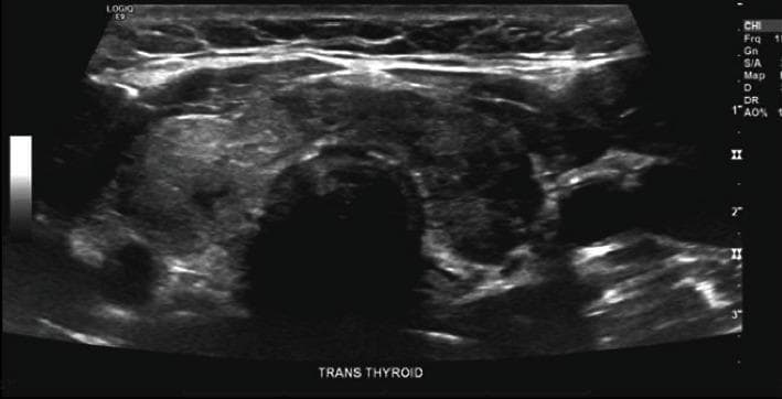 This diagnostic ultrasound image displays a transverse view of the thyroid gland. The gland exhibits thyromegaly, or general enlargement, with a notably heterogeneous echotexture across both the right and left lobes. Located within the central isthmus are two small, solid, hypoechoic nodules, approximately 4 mm in size, which appear darker relative to the surrounding thyroid parenchyma. The trachea is visible as a central shadowed area inferior to the isthmus. This imaging study is representative of subacute thyroiditis or inflammatory thyroid conditions where diffuse parenchymal changes and focal nodules are present. The image provides clinical evidence for evaluating anterior neck swelling and tenderness in an endocrine context.