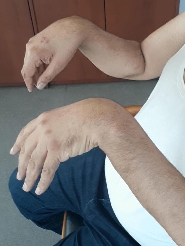 Clinical photograph showing a patient with bilateral wrist drop, a classic neurological sign of radial nerve palsy. The image captures both forearms in a pronated position with the hands hanging limply in passive flexion at the wrist joints. There is a visible inability to maintain extension of the wrists and digits against gravity, indicating significant weakness or paralysis of the extensor muscles (including the extensor carpi radialis longus/brevis, extensor digitorum communis, and extensor indicis proprius). The skin on the dorsal aspect of the hands and distal forearms shows scattered, hyperpigmented macules and patches. This presentation is characteristic of peripheral compressive neuropathy of the radial nerve, often occurring at the spiral groove of the humerus. The visual evidence supports a diagnosis of severe motor deficit in the radial nerve distribution, commonly associated with prolonged external pressure or 'Saturday night palsy' scenarios.