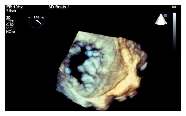 This diagnostic image is a three-dimensional transesophageal echocardiogram (3D TEE) providing a 'surgeon's view' of the aortic valve. The visual demonstrates severe degenerative calcific aortic stenosis. The three aortic valve leaflets exhibit significant pathological changes, including extensive, heterogeneous calcification visualized as bright, irregular, and thickened echogenic masses. These calcific deposits are widespread across the leaflet tissue and the annulus, resulting in marked structural distortion and restricted leaflet mobility. The central orifice is significantly narrowed, characteristic of high-grade stenosis. Surrounding the calcified valve, there is evidence of tissue remodeling, likely representing fibrosis or lipid deposition associated with advanced valvular heart disease. This image serves as a critical educational tool for identifying structural valvular abnormalities and pre-procedural planning for interventions such as transcatheter aortic valve replacement (TAVR), particularly in assessing annular dimensions and the severity of calcification.