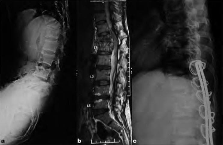 This composite figure displays diagnostic and postoperative imaging of the thoracolumbar spine in a patient with Pott’s disease (spinal tuberculosis). Image (a) is a lateral preoperative X-ray showing a sharp 38° kyphotic angulation at the D12 level, caused by a complete collapse of the D12 vertebral body. Image (b) is a midsagittal T2-weighted MRI, highlighting the marrow signal changes and anterior panvertebral involvement at D12, resulting in focal spinal angulation and narrowing of the spinal canal. Image (c) is a lateral postoperative X-ray demonstrating surgical correction of the kyphosis. The reconstruction features a tricortical bone graft placed anteriorly to restore vertebral height and a posterior Hartshill rectangle fixation system. This hardware consists of two vertical rods secured to the posterior elements by multiple sublaminar wires. The images illustrate the surgical management of spinal tuberculosis through single-stage anterior decompression, bone grafting, and posterior stabilization.