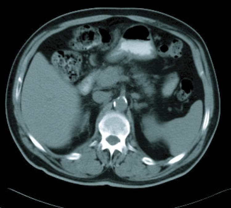 This diagnostic image is an axial contrast-enhanced computed tomography (CT) scan of the upper abdomen. Anatomical landmarks include the liver in the right upper quadrant, the spleen in the left upper quadrant, the stomach containing air and fluid in the midline/left, and the vertebral body of the spine located posteriorly. The liver and spleen appear relatively homogeneous in density. Of clinical significance, the scan demonstrates multiple soft tissue densities in the mesenteric and retroperitoneal regions, consistent with lymphadenopathy. A small, high-density calcification is visible anterior to the spinal column, likely associated with the abdominal aorta or surrounding nodal structures. There is no evidence of gross ascites in the peritoneal spaces. This image serves as a radiological reassessment for gastric adenocarcinoma staging and treatment response, illustrating the monitoring of lymphadenopathy and gastric wall thickening following chemotherapy cycles. It is suitable for medical education regarding abdominal cross-sectional anatomy and oncological imaging evaluation.