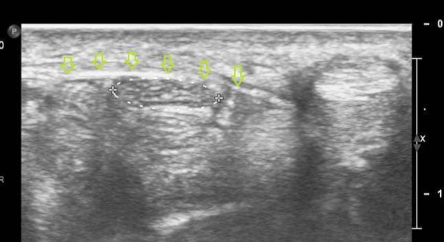 This diagnostic image is a high-resolution musculoskeletal ultrasound of the wrist in the axial (transverse) plane, focusing on the carpal tunnel anatomy. The image demonstrates the spatial relationship between superficial and deep structures of the volar wrist. The flexor retinaculum (transverse carpal ligament) is identified by a series of downward-pointing void arrows, appearing as a thin, hyperechoic (bright) linear band positioned superficially. Located immediately deep to this ligament is the median nerve, which is circumscribed by a dotted oval line. The nerve exhibits a characteristic speckled or 'honeycomb' internal texture and is slightly hypoechoic compared to the overlying retinaculum. This visual representation is clinically significant for evaluating carpal tunnel syndrome, identifying nerve compression, or guiding interventional procedures such as hydrodissection. The imaging captures the typical anatomical boundaries of the carpal tunnel, useful for intermediate to advanced medical students and radiology residents in mastering musculoskeletal sonography and ultrasound-guided regional anesthesia techniques.