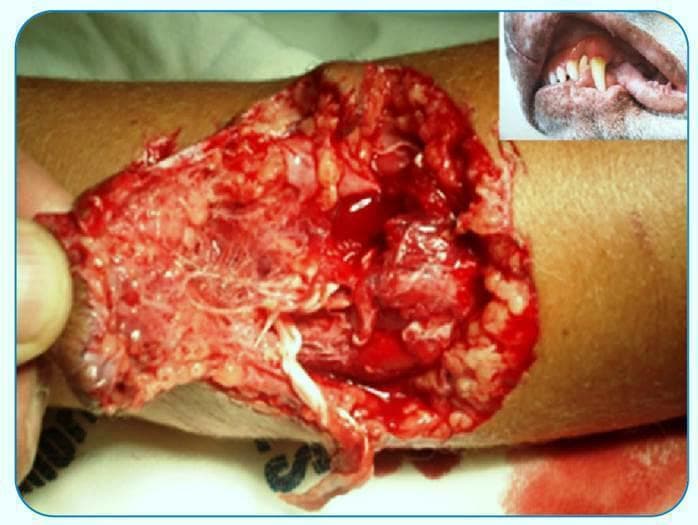 This clinical photograph displays a severe trauma injury on a human limb, identified as a dog bite with massive tissue destruction. The wound is a deep, irregular laceration with ragged edges and significant loss of skin and subcutaneous layers. Exposed anatomical structures include dark red, fibrous skeletal muscle, yellowish lobular adipose tissue, and white, stringy tendon fibers. The wound bed appears macerated with fresh blood and pooling, indicative of acute hemorrhage. An inset image shows the dentition of a domestic dog (Canis lupus familiaris), highlighting the prominent, sharp canine teeth responsible for the penetrating and crushing mechanism of the injury. The educational focus is on wound morphology following animal attacks, demonstrating the potential for complex trauma involving multiple tissue planes and the high risk for secondary bacterial infection and necrosis.