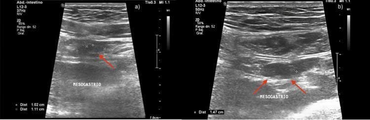 Two grayscale abdominal ultrasound images (a and b) demonstrating clinical findings consistent with mesenteric adenitis. The images focus on the mesogastrium region using a high-frequency linear transducer. Image (a) reveals multiple clustered, hypoechoic, oval-shaped structures representing enlarged mesenteric lymph nodes, with electronic calipers measuring approximately 1.02 cm and 1.11 cm. Red arrows highlight the largest nodes. Image (b) shows a prominent, swollen hypoechoic lymph node with a measurement of 1.47 cm. Trace anechoic free fluid is visible in the surrounding peritoneal space, particularly noted in the clinical context of the right iliac fossa. The lack of appendiceal wall thickening or surrounding fat stranding helps differentiate this from acute appendicitis. This diagnostic imaging serves as a pedagogical example for identifying pediatric or adolescent mesenteric lymphadenopathy and evaluating non-specific abdominal pain.