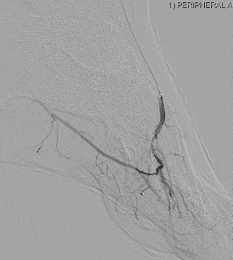 This diagnostic image is a peripheral digital subtraction angiogram (DSA) of the left foot, demonstrating post-intervention revascularization in a patient with peripheral artery disease (PAD) and critical limb ischemia. The image shows the distal anterior tibial artery and the dorsalis pedis artery with clear contrast opacification. A guidewire and an interventional balloon catheter are visible within the arterial lumen, positioned for balloon angioplasty to resolve a previous occlusion. The angiogram illustrates the restoration of flow into the plantar arch and smaller pedal branches. The vessel diameter appears relatively smooth and patent following the atherectomy and angioplasty procedure, with no evidence of residual high-grade stenosis or acute occlusion in the visualized field. This educational material highlights the interventional management of infrapopliteal arterial disease and the technical execution of pedal revascularization to improve distal perfusion.