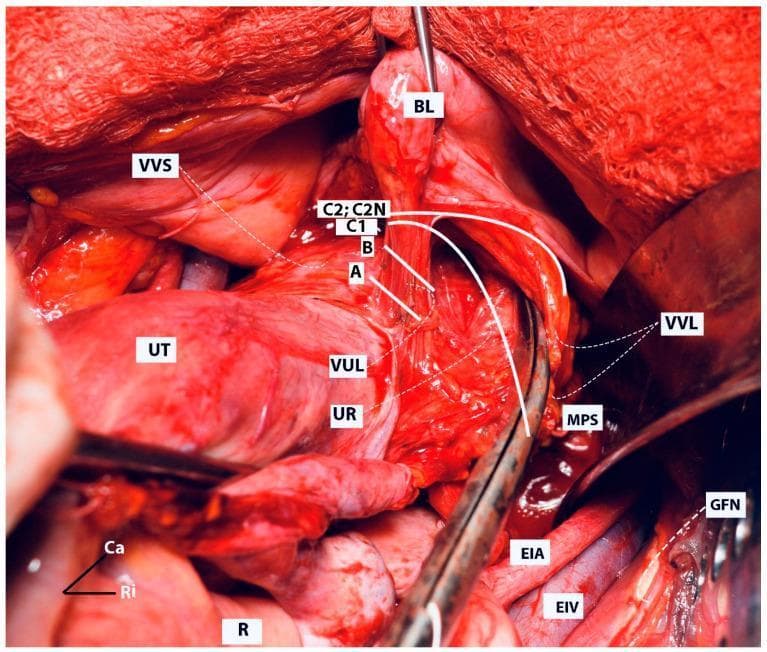 An intraoperative clinical photograph from a radical hysterectomy illustrating the surgical anatomy of the ventral parametrium. The image depicts the pelvic cavity with labels for the uterus (UT), bladder (BL), and rectum (R). The ureter (UR) is shown in relation to the vesicouterine ligament (VUL) and vesicovaginal ligament (VVL). Anatomical landmarks include the medial paravesical space (MPS), vesicovaginal space (VVS), external iliac artery (EIA), external iliac vein (EIV), and genitofemoral nerve (GFN). Overlayed white curves represent four distinct surgical resection lines corresponding to different classes of radicality: Type A (pericervical adventitia), Type B (ureteric level), Type C1 (partial nerve-sparing), and Type C2/C2N (selective-systematic nerve-sparing). The diagram illustrates how the extent of resection progresses laterally from line A to C2N, emphasizing the surgical planes used to tailor radicality while attempting to preserve autonomic pelvic nerves. Orientation is indicated by caudal (Ca) and right (Ri) markers.