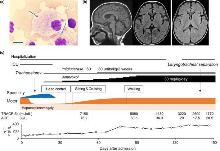 This composite educational graphic details the diagnosis, neuroimaging, and treatment response for a patient with Gaucher disease. (a) A high-power light micrograph of a May-Grünwald-Giemsa stained bone marrow smear reveals characteristic Gaucher cells (arrows), which are large macrophages featuring voluminous, pale, 'crinkled paper' or striated cytoplasm. A 10 μm scale bar is included for reference. (b) Neuroradiological assessment includes a sagittal T1-weighted MRI and axial FLAIR images from day 24 of admission and a follow-up axial FLAIR at 3 months post-discharge, all demonstrating normal brain parenchyma without degenerative or inflammatory lesions. (c) A comprehensive clinical timeline tracks therapeutic interventions, including Imiglucerase and Ambroxol, against clinical milestones. The chart correlates pharmacological dosing with motor development (head control to walking), reduction in hepatosplenomegaly, and improvements in laboratory biomarkers such as Tartrate-Resistant Acid Phosphatase 5b (TRACP-5b), Angiotensin-Converting Enzyme (ACE), and platelet (PLT) counts over a 150-day period.