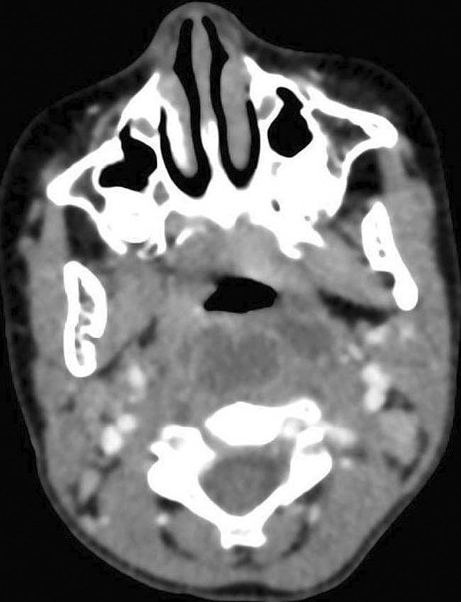 This diagnostic image is an axial CT scan of the head and neck with intravenous contrast. The scan shows a well-defined, low-density fluid collection in the retropharyngeal space, characteristic of a retropharyngeal abscess. The primary lesion is centrally located, measuring approximately 3.7 x 1.5 cm, and exhibits peripheral rim enhancement. Two smaller adjacent satellite collections are visible, suggesting multi-loculated fluid or local spread of infection. Anatomical landmarks include the nasal cavity and maxillary sinuses anteriorly, the oropharynx, and the cervical vertebrae (C1/C2 level) posteriorly. The surrounding soft tissues show evidence of edema and inflammatory changes, manifesting as increased mottled density and obliteration of normal tissue planes. The image is clinically significant for diagnosing deep neck space infections and evaluating potential complications such as airway compromise or posterior extension into the 'danger space' and epidural space. This material is suitable for intermediate to advanced medical learners focusing on radiology, otolaryngology, and emergency medicine.
