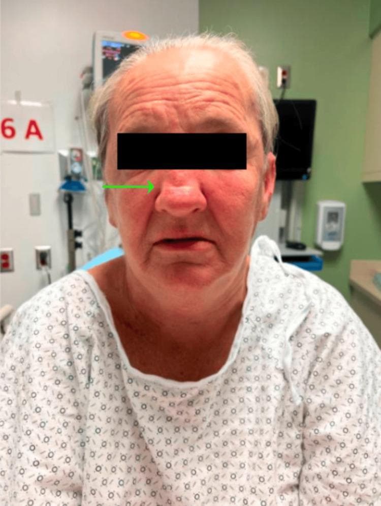 Clinical photograph of an adult female patient in a hospital setting demonstrating classic physical signs associated with Superior Vena Cava (SVC) Syndrome. The image shows significant, diffuse facial edema (facial plethora) and generalized erythema, particularly prominent in the periorbital and midfacial regions. The swelling appears slightly asymmetric, with greater involvement of the patient's left side. A green arrow highlights a distinct saddle nose deformity, characterized by a collapse of the nasal bridge. The patient exhibits a mildly anxious expression and is seated in a clinical environment, wearing a standard patterned hospital gown. This visual presentation illustrates the physical manifestations of venous congestion and obstruction often caused by mediastinal masses or thoracic malignancies, such as small-cell lung cancer (SCLC). The image is an educational example of oncologic or vascular emergencies and the importance of physical examination in diagnosing obstructive venous syndromes.