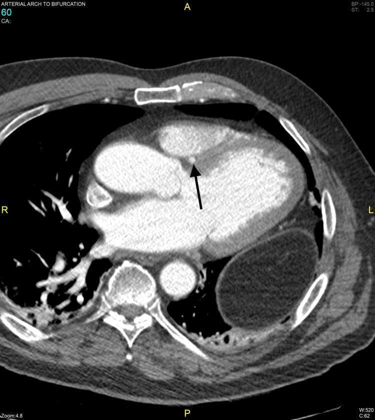 This diagnostic axial CT angiography (CTA) image provides a cross-sectional view of the mid-thoracic cavity, specifically focused on cardiac and mediastinal anatomy. The scan demonstrates the four heart chambers and the descending aorta. A primary clinical finding is an anomalous Left Main Coronary Artery (LMCA) highlighted by a black arrow. The vessel is shown following a septal course, traversing the interventricular septum between the right and left ventricular outflow regions. The image allows for assessment of the arterial caliber and relationship to surrounding myocardial structures, specifically looking for evidence of intra-arterial or intramyocardial compression. Other visible landmarks include the sternum anteriorly, vertebral bodies posteriorly, and bilateral lung parenchyma. This image is a critical educational resource for understanding coronary artery anomalies and the use of gated CTA in evaluating vascular pathways relative to cardiac anatomy.