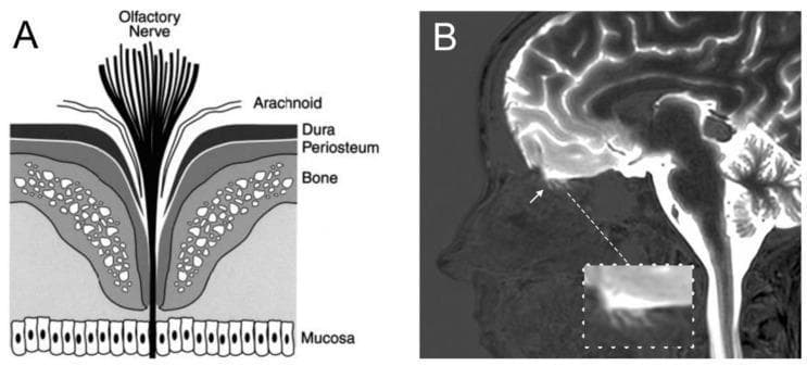 This dual-panel image illustrates the anatomical and functional barrier between the cranial and nasal cavities at the cribriform plate. Panel A is an anatomical diagram showing the layered organization of the cribriform region. From superior to inferior, it depicts the olfactory nerve bundles passing through the arachnoid, dura, periosteum, and the fenestrated bone of the cribriform plate to reach the respiratory mucosa. The diagram highlights how olfactory sensory neurons bridge the subarachnoid space and the nasal environment. Panel B is a sagittal T1-weighted MRI of the human head following intrathecal administration of a gadolinium-based contrast agent (gadobutrol). Bright signal enhancement indicates high contrast concentration throughout the cerebral subarachnoid space, cerebral convexities, and around the brainstem and spinal cord. An inset focuses on the cribriform plate (indicated by a white arrow), showing that while gadolinium penetrates the superior aspect of the cribriform fenestrations, it does not enter the nasal mucosa. This image demonstrates the clinical relevance of the blood-CSF barrier and evaluates the potential for CSF drainage into the lymphatic system through the olfactory pathway.