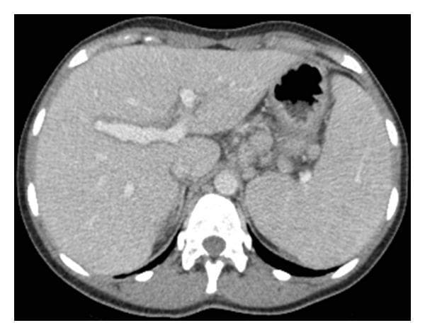 This diagnostic image is an axial contrast-enhanced CT scan of the upper abdomen. The primary findings include mild hepatomegaly and splenomegaly (enlargement of the liver and spleen). The liver parenchyma appears relatively homogeneous without focal mass lesions or obvious biliary dilatation. The spleen is prominently sized, extending anteriorly and medially. Other visible anatomical structures include the vertebral column and posterior paraspinal musculature, the abdominal aorta, the stomach containing gas and heterogeneous content, and the surrounding abdominal wall. The scan is utilized in the context of acute liver injury to assess for gross anatomical abnormalities or signs of chronic liver disease, such as cirrhosis or portal hypertension. The educational focus is on identifying organomegaly in the setting of acute hepatitis or drug-induced liver injury (DILI).