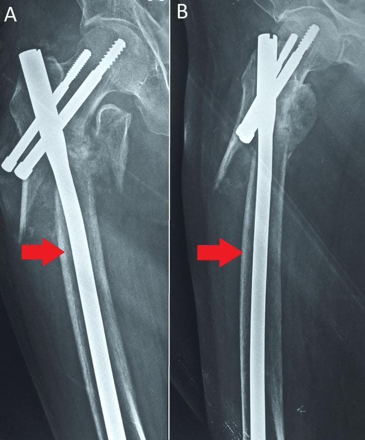 Diagnostic radiographic images (X-rays) of the proximal femur demonstrating surgical stabilization of an intertrochanteric fracture using a Proximal Femoral Nail (PFN). Panels A and B show an anteroposterior view of the hip and proximal femur. The hardware consists of a metallic intramedullary nail (indicated by red arrows) inserted into the femoral shaft canal, through which cephalocervical screws are passed into the femoral neck and head to provide stability and compression. In image A, a distinct intertrochanteric fracture line with fragmentation is visible, showing signs of internal fixation and alignment maintenance. The bone demonstrates varying radiolucency, which may suggest underlying osteopenia or osteoporosis. This imaging is characteristic of orthopedic trauma management, specifically the internal fixation of hip fractures to facilitate healing and early mobilization. The specialty focus is Orthopedic Surgery and Traumatology.