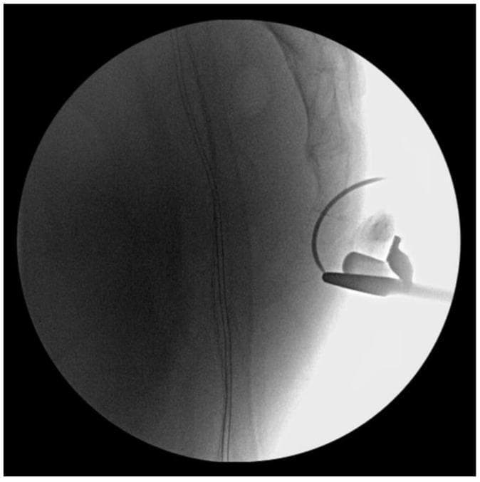 Lateral view intraoperative fluoroscopic image of the sacrococcygeal region during a surgical reduction procedure. The radiopaque structures of the distal sacrum and coccyx are visible. A Freer periosteal elevator is shown in situ, positioned against the anterior aspect of the sacrococcygeal joint. The instrument acts as a lever, resting on the distal sacral segment to provide posterior traction on the dislocated coccyx, facilitating alignment. Additionally, a curved surgical needle and suture material are visible, demonstrating the technique for a trans-osseous vertical suture to stabilize the joint post-reduction. This image illustrates the orthopedic management of traumatic anterior coccygeal dislocation and the use of manual surgical instruments for joint reduction under real-time imaging guidance.