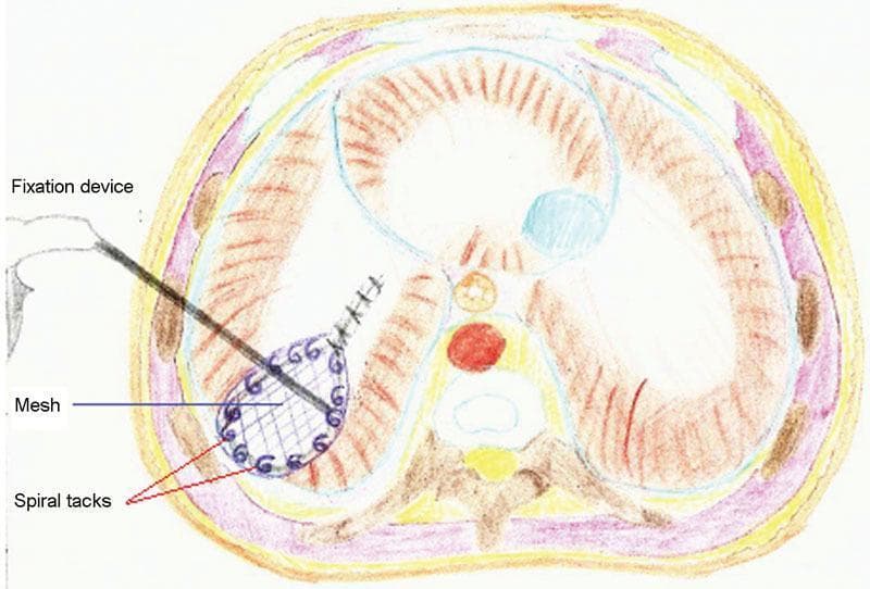 This medical illustration depicts a cross-sectional anatomical diagram of the trunk, specifically highlighting a surgical repair of a posterolateral diaphragmatic defect (likely a Bochdalek hernia). The central focus is on a prosthetic mesh patch, shown as a grid-like structure, positioned to close the opening in the diaphragm. The mesh is secured to the surrounding diaphragmatic tissue and adjacent thoracic wall structures using several non-absorbable spiral tacks, which are visible around the perimeter of the patch. A laparoscopic fixation device is illustrated in the act of applying or positioning the mesh. The surrounding anatomy includes the vertebral column, major vessels such as the aorta, and the musculature of the abdominal and thoracic walls. This educational diagram demonstrates the technique of tension-free prosthetic repair in cases where primary suture closure is insufficient, illustrating a common approach in pediatric or adult thoracic surgery.
