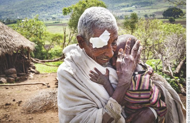 This clinical photograph displays an elderly male patient in a rural, resource-limited setting, specifically Burkina Faso, post-ophthalmic intervention. The patient's left eye is occluded with a white surgical adhesive bandage, typically indicative of immediate postoperative care following sight-restoring procedures such as cataract surgery or trichiasis repair. The surrounding facial skin shows significant solar elastosis and dermatological aging, consistent with chronic ultraviolet exposure in a tropical climate. The image illustrates the delivery of primary eye health care and specialized surgical outreach in remote communities. The background features a thatched-roof dwelling and mountainous agricultural landscape, emphasizing the socioeconomic and geographical barriers to healthcare access. This visual is used to demonstrate the impact of community-based ophthalmology and public health initiatives in preventing avoidable blindness in underserved populations.