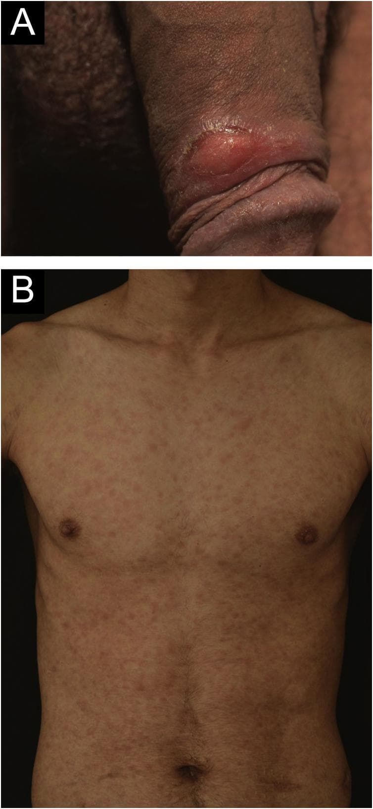 Two-panel clinical photograph illustrating manifestations of syphilis in a 24-year-old male. Panel A (top) is a close-up clinical photograph of the male genitalia showing a solitary, well-demarcated genital ulcer (chancre) located on the foreskin. The lesion exhibits clean, well-defined edges and an erythematous, indurated base, characteristic of primary syphilis. Panel B (bottom) is an anterior clinical photograph of the patient's trunk demonstrating a diffuse, symmetrical cutaneous eruption. The rash consists of multiple, discrete, erythematous maculopapular lesions distributed across the chest and abdomen. These findings represent secondary syphilis occurring concurrently with the resolving primary lesion. The images serve as an educational resource for identifying the clinical progression of Treponema pallidum infection, particularly in immunocompromised patients such as kidney transplant recipients.