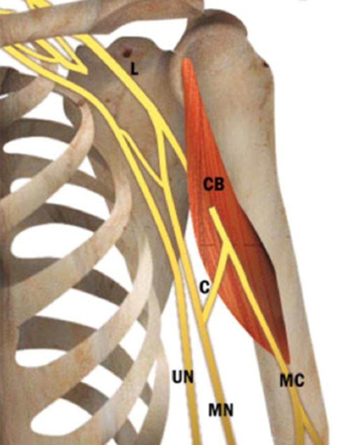 This anatomical diagram illustrates a common neuroanatomical variation of the brachial plexus in the upper limb, specifically the shoulder and proximal humerus region. The visual features the skeletal framework of the rib cage, clavicle, and humerus, with the coracobrachialis muscle (CB) highlighted in red. The neural structures are depicted in yellow, demonstrating the relationship between the musculocutaneous nerve (MC), median nerve (MN), and ulnar nerve (UN). A significant anatomical variant is shown: a communicating branch (C) originating from the musculocutaneous nerve distal to its exit from the coracobrachialis muscle. This branch travels medially and distally to join the median nerve. This illustration is an educational resource for medical students and clinicians to understand variations in peripheral nerve anatomy, which is critical for surgical planning in the axillary region and for interpreting unusual clinical presentations of peripheral nerve injuries.