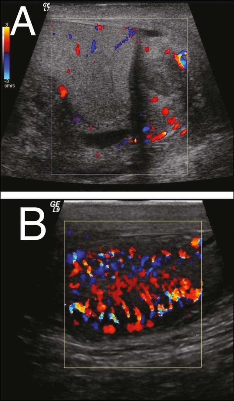 Two color Doppler ultrasound images (A and B) of the scrotal contents demonstrating findings consistent with epididymo-orchitis. Image A displays the epididymis, which appears enlarged and heterogeneous with an irregular echotexture. The color Doppler overlay reveals focal hypervascularity (hyperemia), indicated by increased red and blue signals within the epididymal tissue. Image B shows the testis, which is similarly enlarged and heterogeneous. The Doppler study in B demonstrates diffuse, intense hypervascularity throughout the testicular parenchyma, often referred to as a 'thyroid storm' or 'inferno' sign in the clinical context of orchitis. These findings illustrate the standard diagnostic radiological approach for differentiating inflammatory conditions from testicular torsion; the presence of increased blood flow is characteristic of infectious or inflammatory processes like epididymitis and orchitis, whereas absent or reduced flow would suggest torsion. The imaging is relevant for urological and emergency medicine education regarding acute scrotum evaluation.