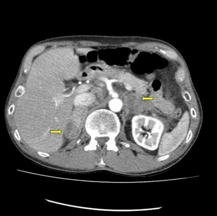 This diagnostic axial CT scan of the abdomen with intravenous contrast demonstrates bilateral adrenal gland pathology. The primary findings are significant bilateral enlargement of the adrenal glands, which exhibit mixed attenuation consistent with acute spontaneous bilateral adrenal hemorrhage. Yellow arrows highlight the areas of involvement, specifically pointing to periadrenal infiltration and stranding in the retroperitoneal fat. These infiltrative changes indicate edema or extravasated blood extending beyond the adrenal capsules. The surrounding anatomy shows the liver, spleen, kidneys, and abdominal aorta. This clinical imaging is characteristic of Waterhouse-Friderichsen syndrome or secondary adrenal insufficiency due to hemorrhage. The educational focus is on identifying acute adrenal morphology changes and recognizing signs of periadrenal inflammation or hemorrhage on cross-sectional imaging.