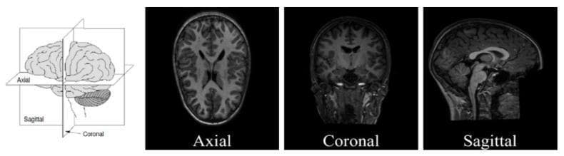 This educational graphic illustrates the primary anatomical planes used in neuroimaging, specifically structural MRI (sMRI). The figure consists of an anatomical diagram followed by three representative diagnostic images. The initial diagram demonstrates the three-dimensional orientation of the axial (transverse), coronal (frontal), and sagittal (longitudinal) planes relative to a human brain model. The subsequent panels present T1-weighted sMRI slices corresponding to these orientations: 1) Axial plane, showing a superior-to-inferior view with visible ventricles and symmetrical cerebral hemispheres; 2) Coronal plane, providing a front-to-back perspective highlighting the brain's vertical structures and cortical thickness; and 3) Sagittal plane, offering a lateral view of the midline structures including the brainstem, cerebellum, and corpus callosum. The educational focus is on standard radiological orientation and spatial classification of neuroanatomical data, essential for diagnostic workflows and computational neuroanalysis, such as Autism Spectrum Disorder (ASD) research.