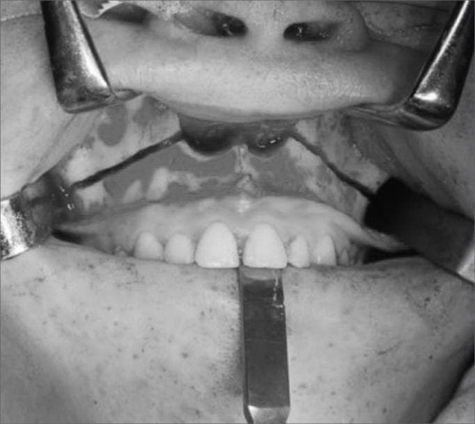This black-and-white clinical photograph displays an intraoperative view of a maxillary Le Fort I osteotomy. The surgical site is accessed through an intraoral approach with the upper lip and labial mucosa retracted superiorly using metal surgical retractors, exposing the maxilla. A clear, horizontal osteotomy line is visible extending across the midface, superior to the apices of the maxillary teeth. The cut originates near the piriform aperture and canine pillar, traversing the lateral maxillary wall. The underlying bone is exposed, and the soft tissues are reflected to provide a clear operative field. A surgical instrument is positioned inferiorly near the midline of the maxillary incisors to stabilize or manipulate the dental arch. This procedure is a fundamental component of orthognathic surgery, often utilized here as part of a transmaxillary approach to access deeper structures such as the clivus or to correct dentofacial deformities.