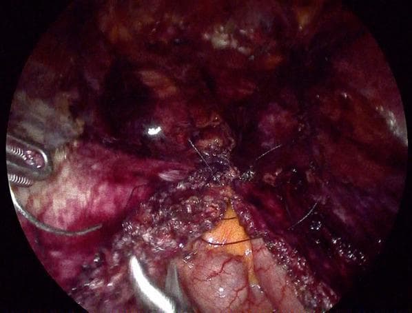 This laparoscopic clinical photograph illustrates an intraoperative view of a posterior layer closure during a ventral hernia repair (VHR). The surgical site shows the approximation of the posterior rectus sheath and peritoneum. The defect has been closed using 3-0 dark-colored multifilament suture material, visible as fine strands across the midline of the repair. The surrounding anatomical environment includes dissected retrorectus and preperitoneal spaces characterized by reddish, vascularized tissue and moist, glistening serosal surfaces. A surgical laparoscopic grasper is visible on the left side of the frame, assisting in tissue manipulation. This image demonstrates a critical step in the enhanced-view totally extraperitoneal (eTEP) technique, where the posterior layer is reconstituted to create a barrier between the abdominal contents and the subsequent mesh reinforcement. The suture technique aims for a tension-free, airtight closure to prevent internal herniation or contact between the mesh and the viscera.