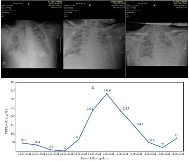 This composite educational graphic displays a serial progression of chest radiographs (A, B, C) and a corresponding line graph of C-reactive protein (CRP) levels (D) in a patient with Acute Respiratory Distress (ARD). Panel A shows initial bilateral diffuse pulmonary opacities and evidence of mechanical ventilation. Panel B, representing the third day of re-admission, demonstrates worsening bilateral alveolar and interstitial infiltrates with visible medical devices, including an endotracheal tube and central venous lines. Panel C, on the sixth day, reveals a slight improvement in lung aeration compared to B, though significant opacity remains. Graph D tracks the biochemical inflammatory response, showing a dramatic spike in CRP levels (reaching 333.6 mg/dL) coinciding with clinical deterioration and septic shock, followed by a decline. This clinical timeline illustrates the correlation between radiological findings of progressive lung injury and laboratory markers of systemic inflammation in critical care medicine.
