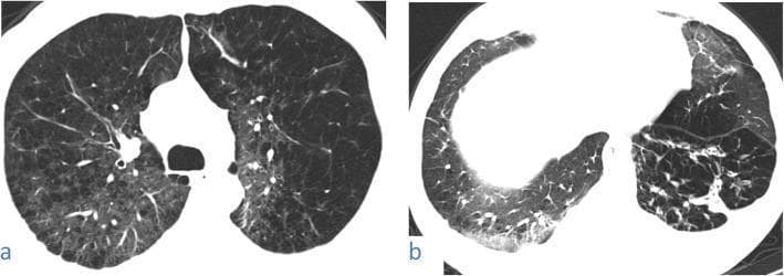 High-resolution axial CT scans of the chest in a 48-year-old male smoker with COVID-19. Image (a) shows the upper lobes featuring marked centrilobular emphysema characterized by multiple lucent spaces centered on secondary pulmonary lobules. This is superimposed with patchy and subpleural ground-glass opacification (GGO), appearing as areas of hazy increased lung density. Image (b) shows the lower lobes, demonstrating peripheral ground-glass opacity in the right lower lobe with associated vascular thickening. The left lower lung shows architectural distortion with visible fibrous stripes and reticular markings. These findings represent a combination of chronic obstructive pulmonary disease (COPD) from smoking history and acute pulmonary manifestations consistent with viral pneumonia (COVID-19), illustrating how pre-existing emphysema can complicate the presentation of infectious lung disease.