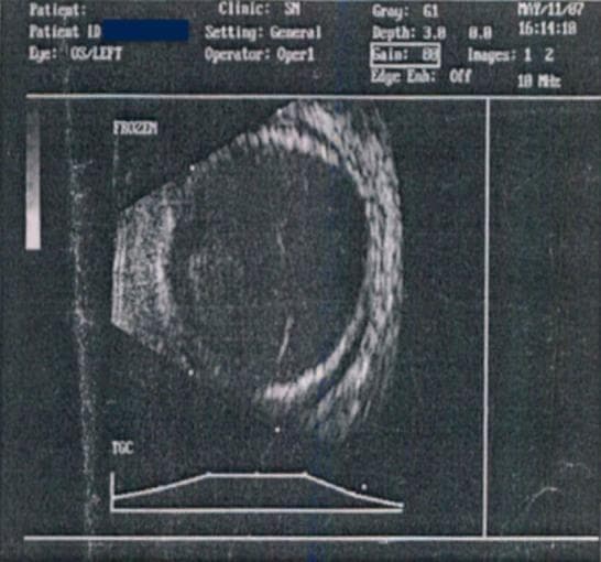 This diagnostic image is a B-scan ultrasonogram (USG) of the left eye (OS), demonstrating significant posterior segment pathology. The ocular B-scan reveals a shallow, 360-degree (circumferential) serous choroidal detachment. This is characterized by the presence of a hypoechoic space between the high-reflectivity sclera and the choroid, showing a characteristic undulating but generally convex-inward configuration. The detachment spans the periphery of the globe. Additional visible features include optic nerve head cupping and thickening of the posterior ocular wall. The anterior segment shows evidence of a flattened chamber and lens opacity consistent with a total cataract. These findings are clinically relevant in the context of secondary glaucoma or vascular anomalies such as a carotid-cavernous fistula (CCF), which can lead to increased venous pressure and subsequent fluid accumulation in the suprachoroidal space. The image serves as a critical educational example of how B-scan ultrasound is used to visualize intraocular structures when direct ophthalmoscopy is obscured by media opacities.