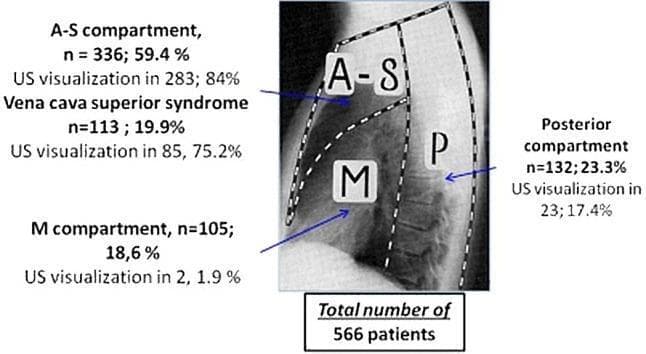 An educational anatomical diagram overlaid on a lateral chest radiograph, illustrating the surgical division of the mediastinum into three primary compartments: Anterior-Superior (A-S), Middle (M), and Posterior (P). The boundaries of these compartments are demarcated by white dashed lines. Annotations provide statistical data from a study of 566 patients regarding the distribution of mediastinal lesions and the success rate of ultrasound (US) visualization within each zone. The A-S compartment contains 59.4% of lesions (n=336) with an 84% US visualization rate. The M compartment contains 18.6% (n=105) with the lowest US visualization at 1.9%. The P compartment contains 23.3% (n=132) with a 17.4% visualization rate. Specifically noted is 'Vena cava superior syndrome' occurring in 19.9% of cases, with 75.2% US visualization. This infographic serves as a clinical guide for thoracic imaging, highlighting the feasibility of US-guided core needle biopsy based on anatomical localization.